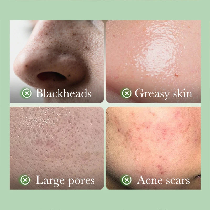 SADOER Salicylic Acid & Niacinamide Face Masks - Anti-Acne & Brightening